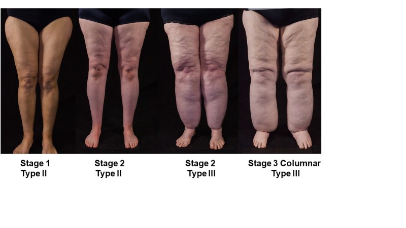Lipedema: The Disease They Call FAT — WITHINGS BLOG