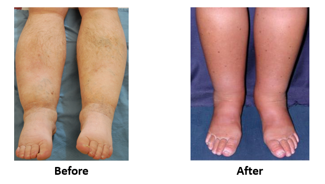 Feet Swelling Treatment Causes Center For Vascular Medicine