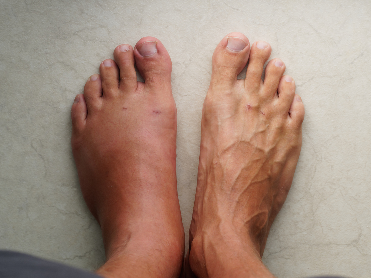 Leg Swelling When I Travel: Should I Be Worried?: Soffer Health
