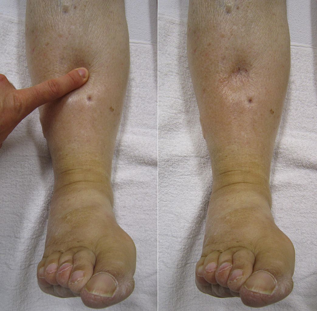 Home Remedies to Treat Edema in Legs and Feet