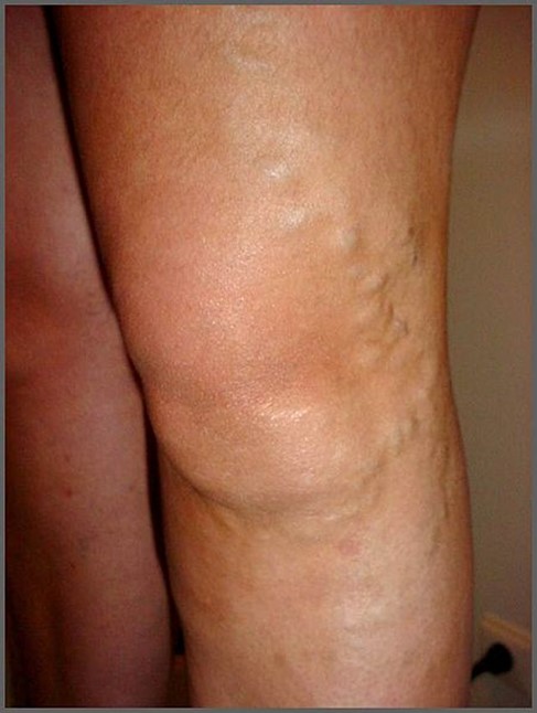 Am I at Risk for Chronic Venous Insufficiency?