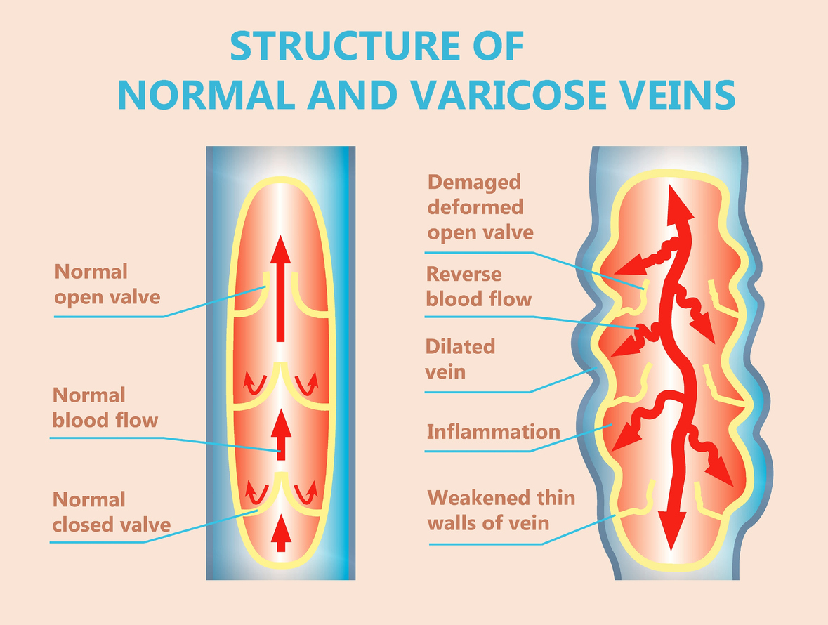 lower extremity venous reflux