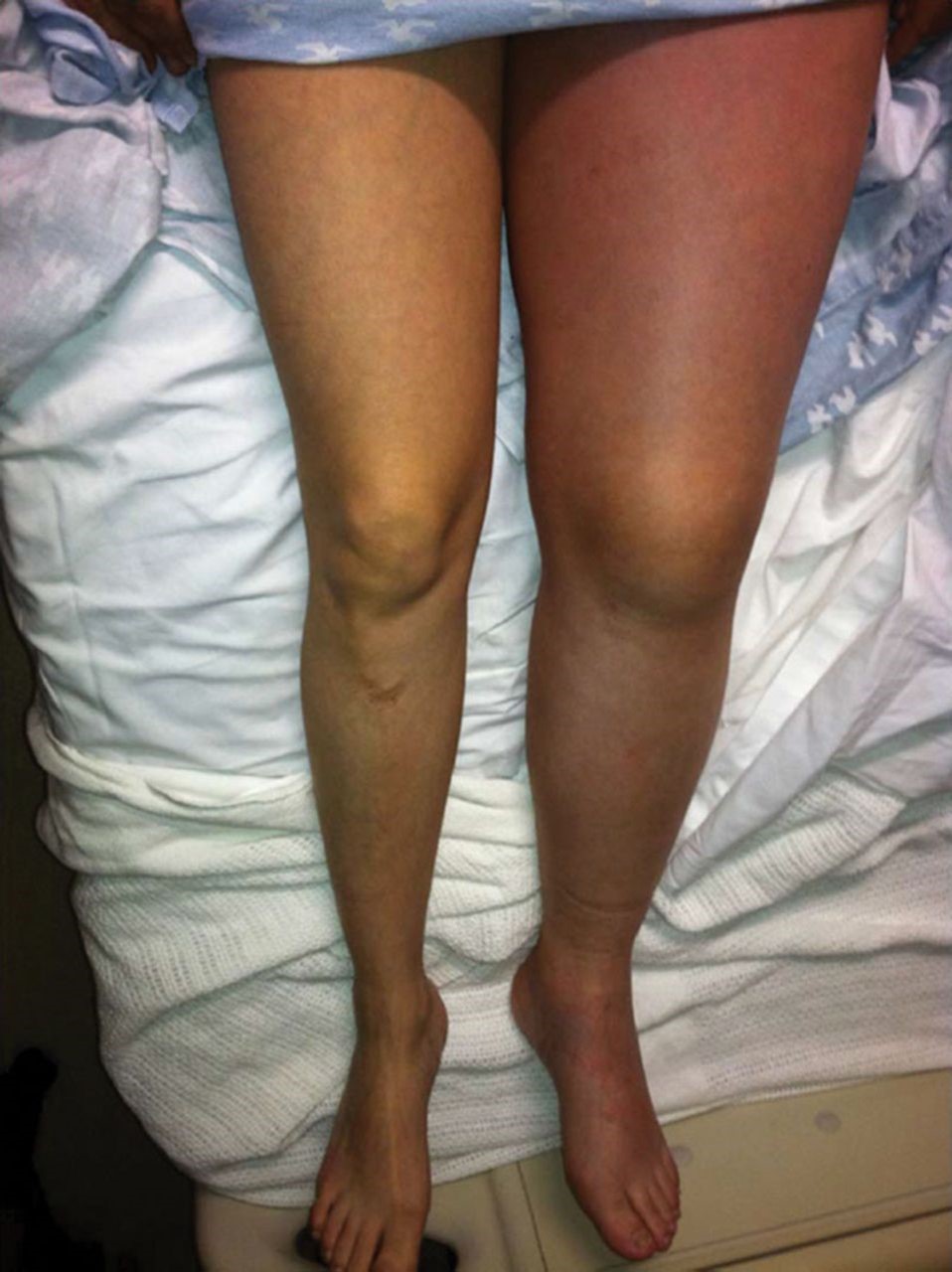 May Thurner Syndrome, Puffy Left Leg, Lymphedema Treatment