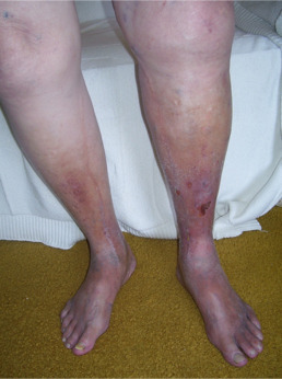 Post-Thrombotic Syndrome: When Deep Vein Thrombosis Causes Long-Term Damage